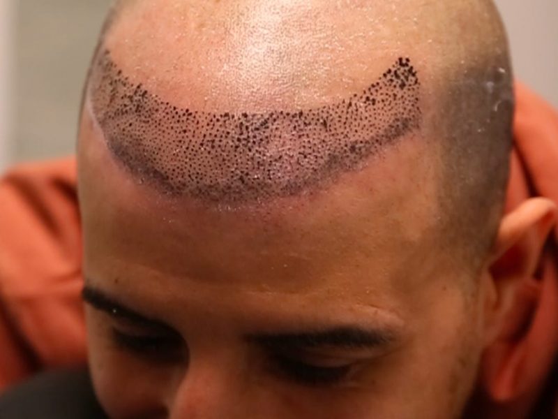 Hairline Tattoo Sydney – Things to Consider Before Getting a Hairline Tattoo