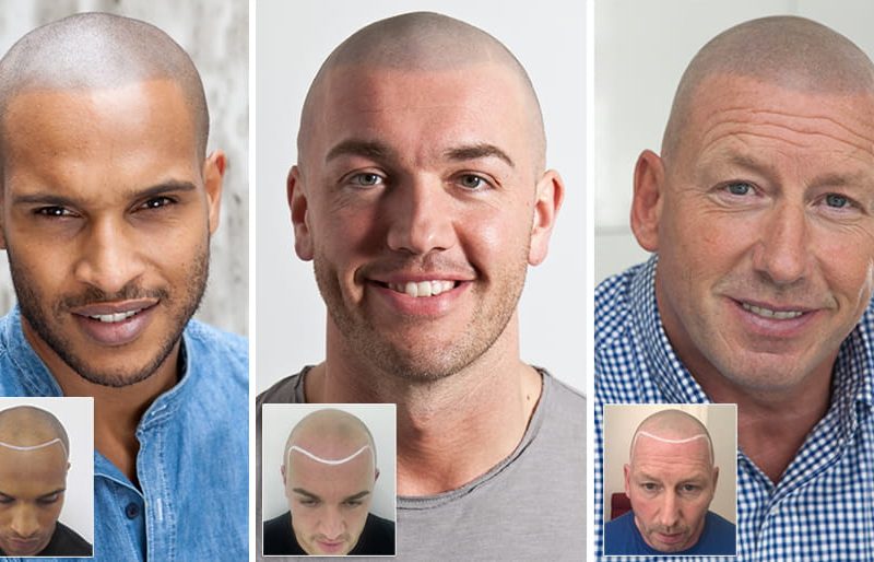 Scalp Micropigmentation Sydney – What You Need to Know