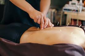Finding Relief Naturally: Acupuncture for Allergies