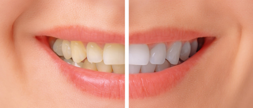 teeth whitening Caringbah
